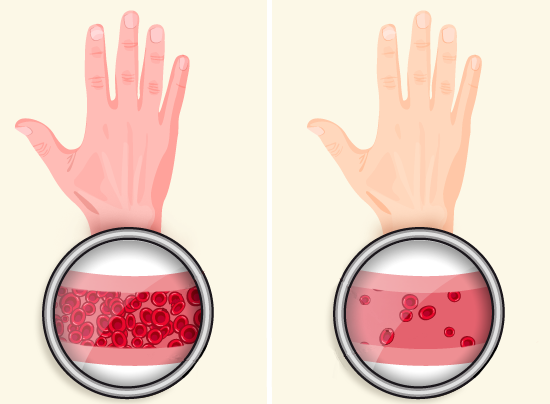 Биохимический анализ крови при анемии, многопрофильная клиника  МедПросвет
