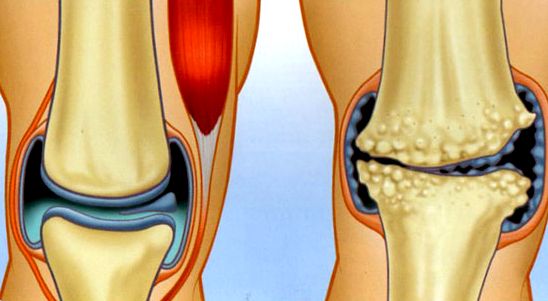 Артроз суставов: причины и лечение
