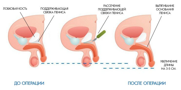 Увеличение (удлинение) полового члена – лечение в Москве в клинике доктора Назимовой