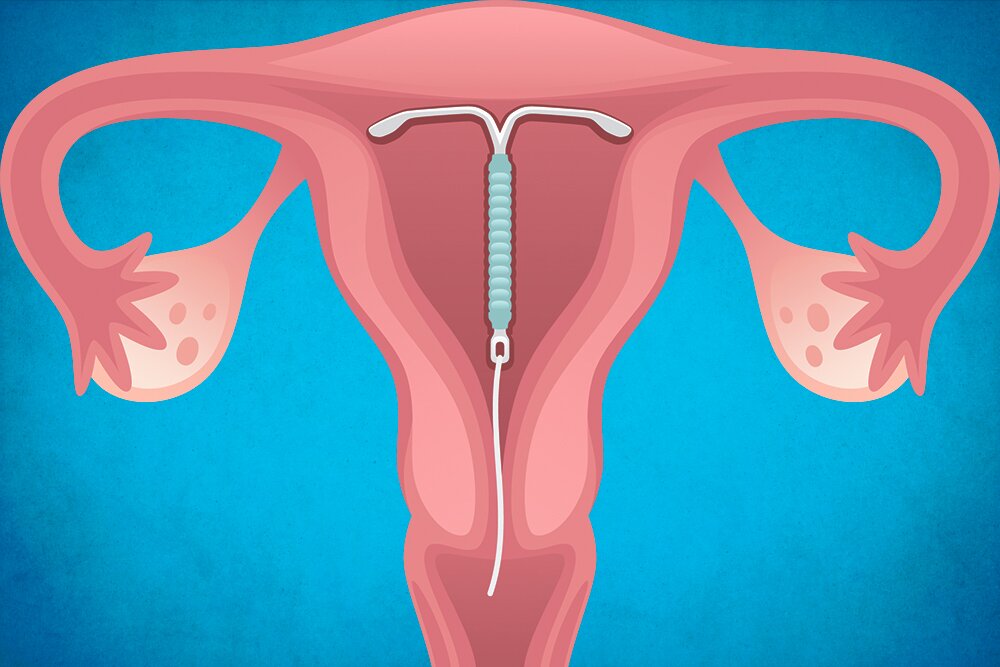 Внутриматочная спираль – все об этом виде контрацепции