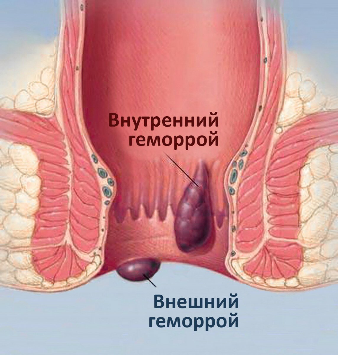 геморроидальные шишки фото